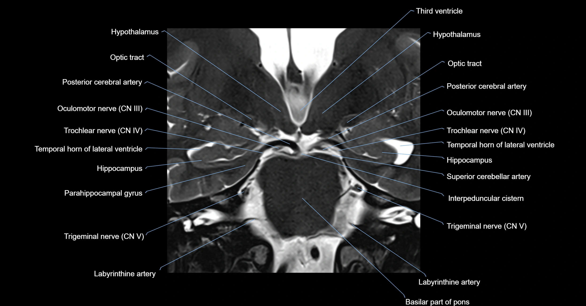 MRI cavernous sinus coronal cross sectional 3T anatomy image-img-00001-00018.webp